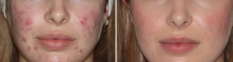 Antes y después: acné inflamatorio y marcas · 6 semanas. Paciente real