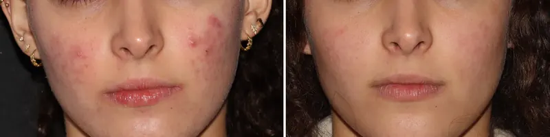 Antes y después: acné inflamatorio y marcas. Paciente real
