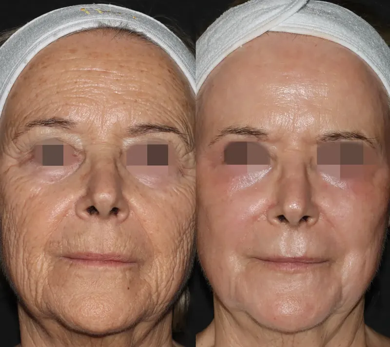 Antes y después: rejuvenecimiento facial con láser co2. Paciente real