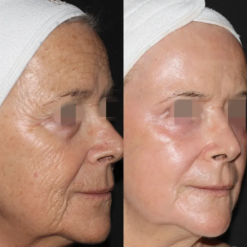 Antes y después: rejuvenecimiento facial con láser co2. Paciente real
