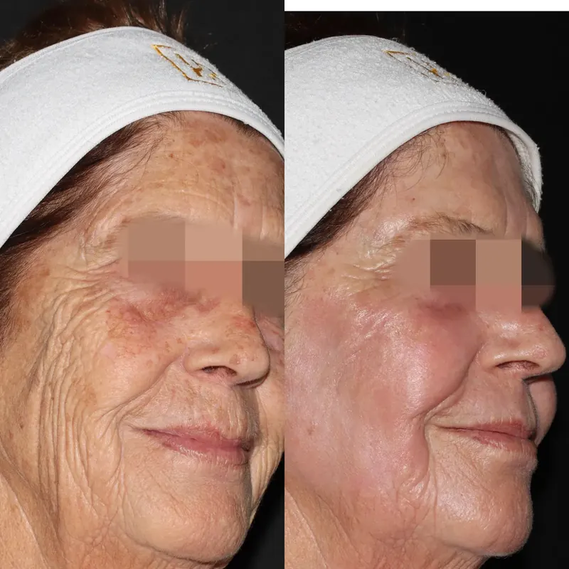 Antes y después: rejuvenecimiento facial con láser co2. Paciente real
