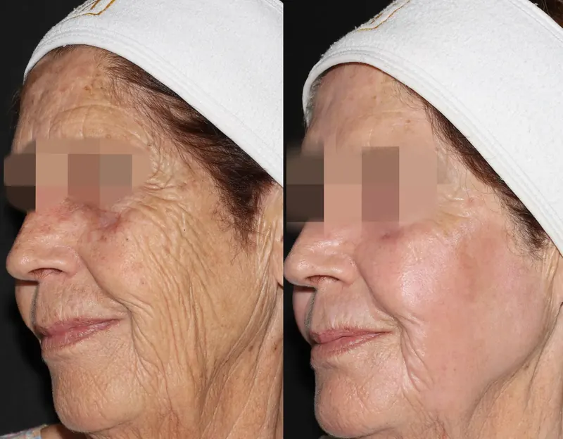 Antes y después: rejuvenecimiento facial con láser co2. Paciente real
