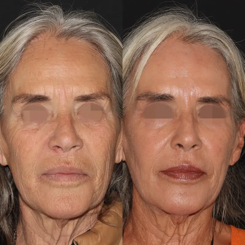 Antes y después: rejuvenecimiento facial con láser co2. Paciente real