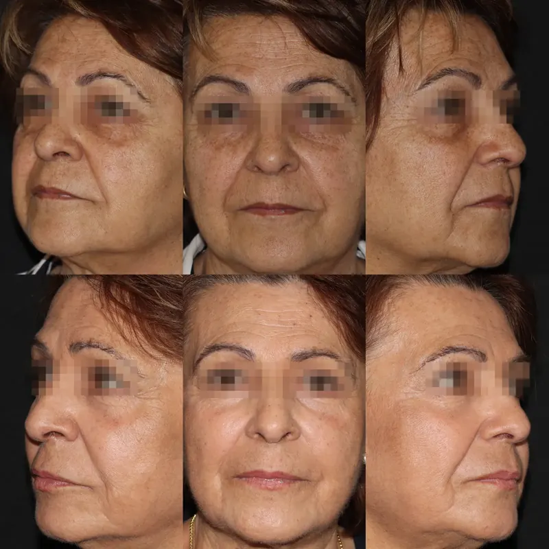 Antes y después: rejuvenecimiento facial con láser co2 · 1 año. Paciente real