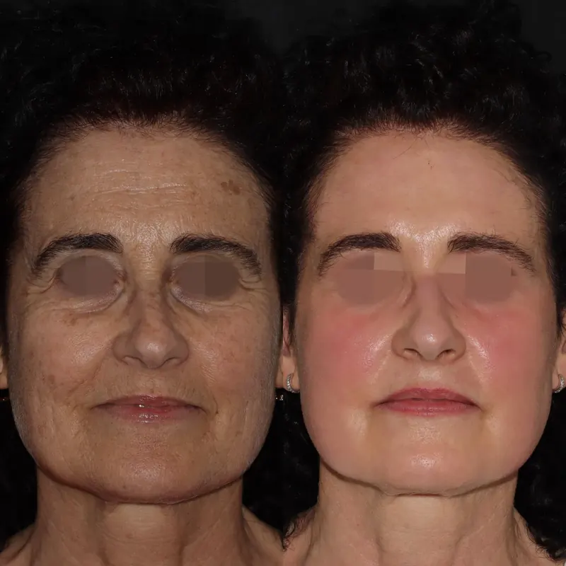 Antes y después: rejuvenecimiento facial con láser co2. Paciente real