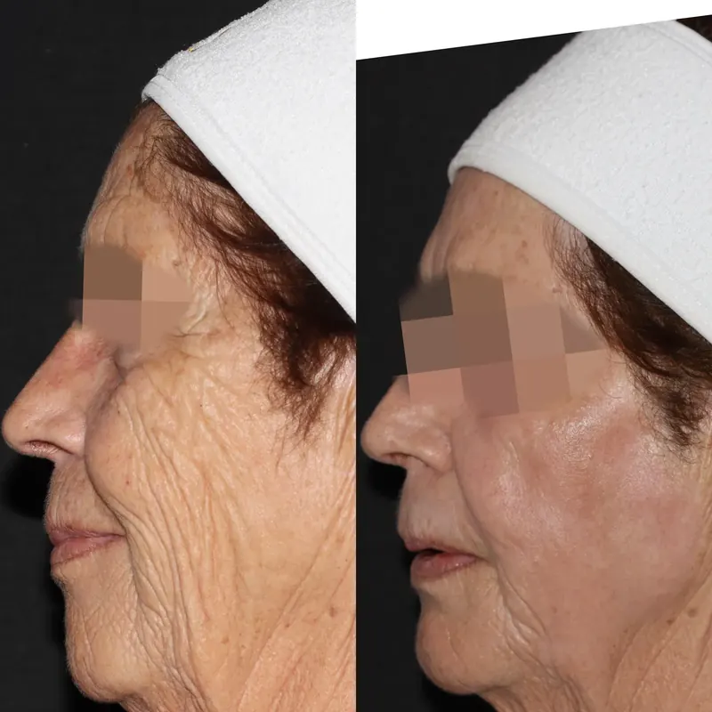 Antes y después: rejuvenecimiento facial con láser co2. Paciente real