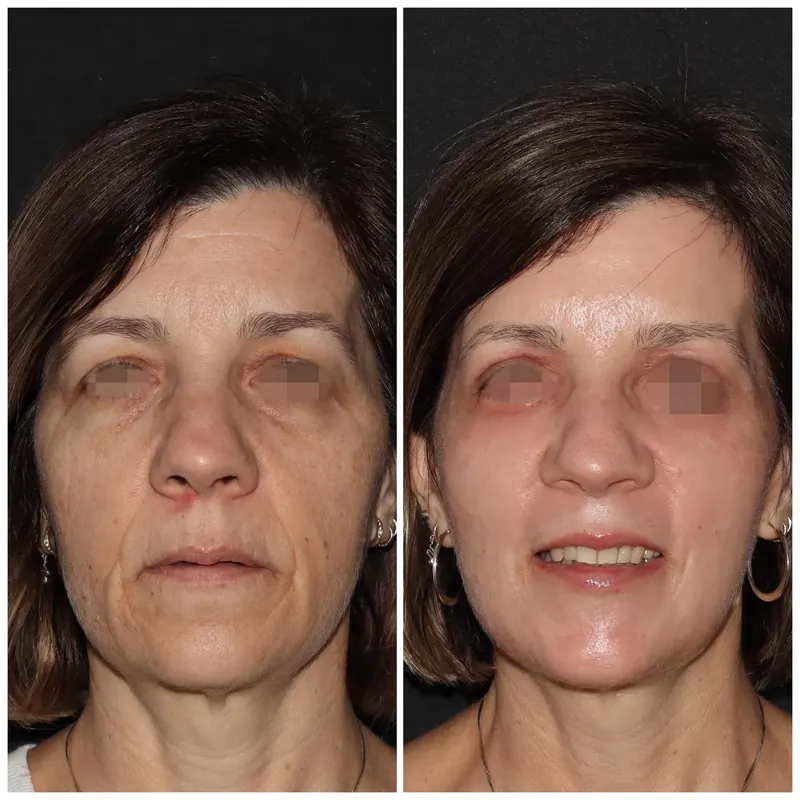 Antes y después: rejuvenecimiento facial con láser co2. Paciente real