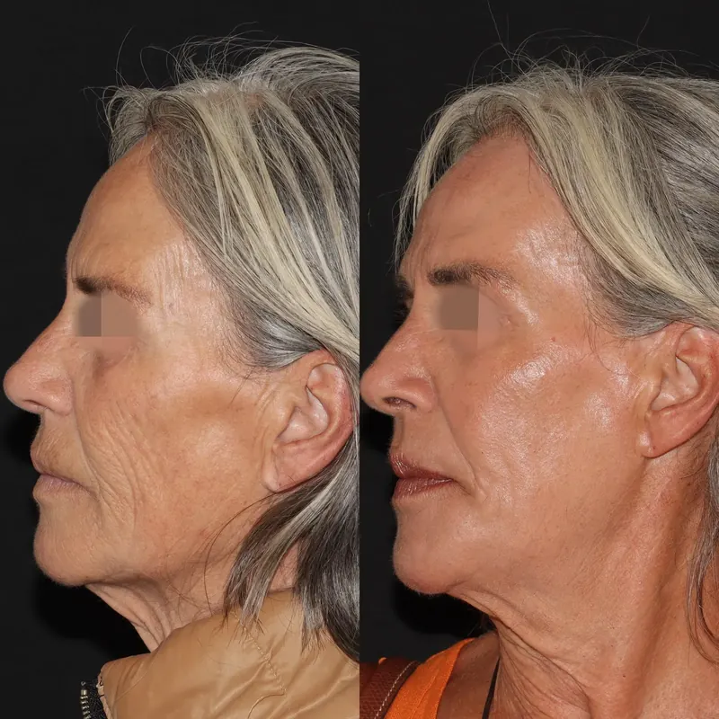 Antes y después: rejuvenecimiento facial con láser co2. Paciente real