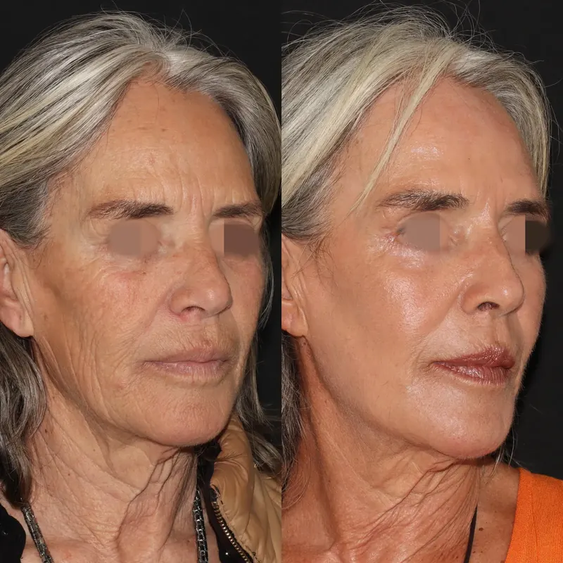 Antes y después: rejuvenecimiento facial con láser co2. Paciente real