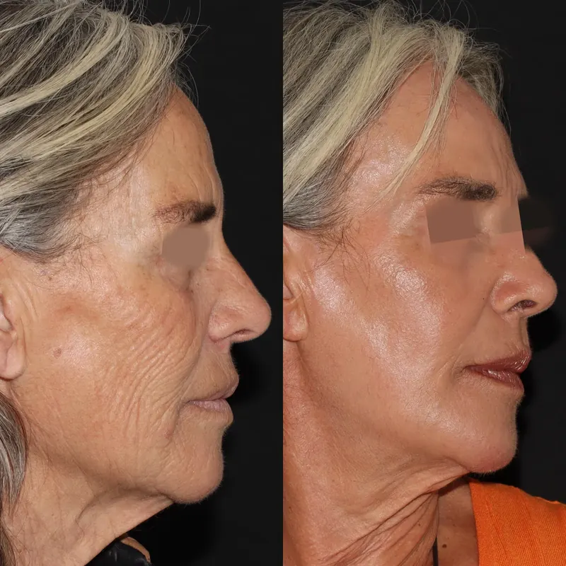 Antes y después: rejuvenecimiento facial con láser co2. Paciente real