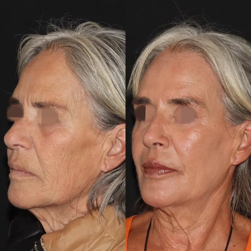 Antes y después: rejuvenecimiento facial con láser co2. Paciente real