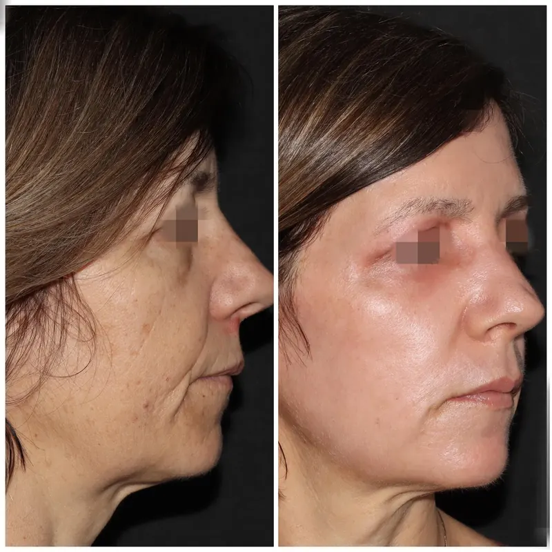 Antes y después: rejuvenecimiento facial con láser co2. Paciente real