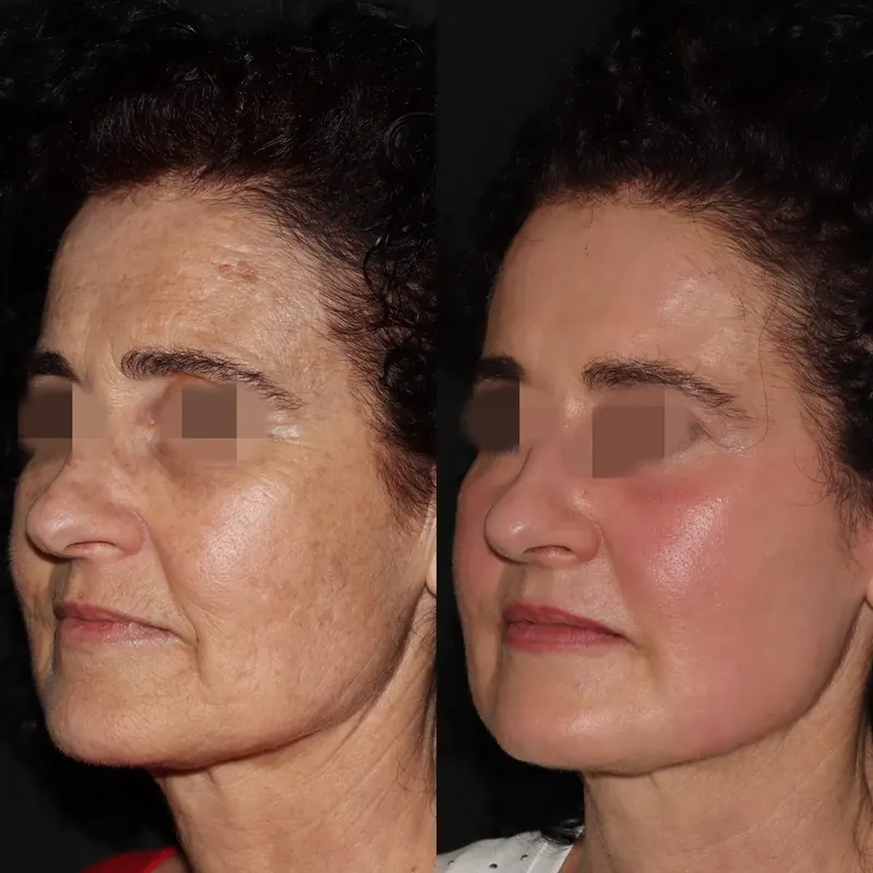 Antes y después: rejuvenecimiento facial con láser co2. Paciente real