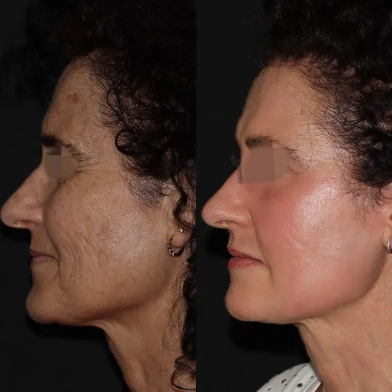 Antes y después: rejuvenecimiento facial con láser co2. Paciente real
