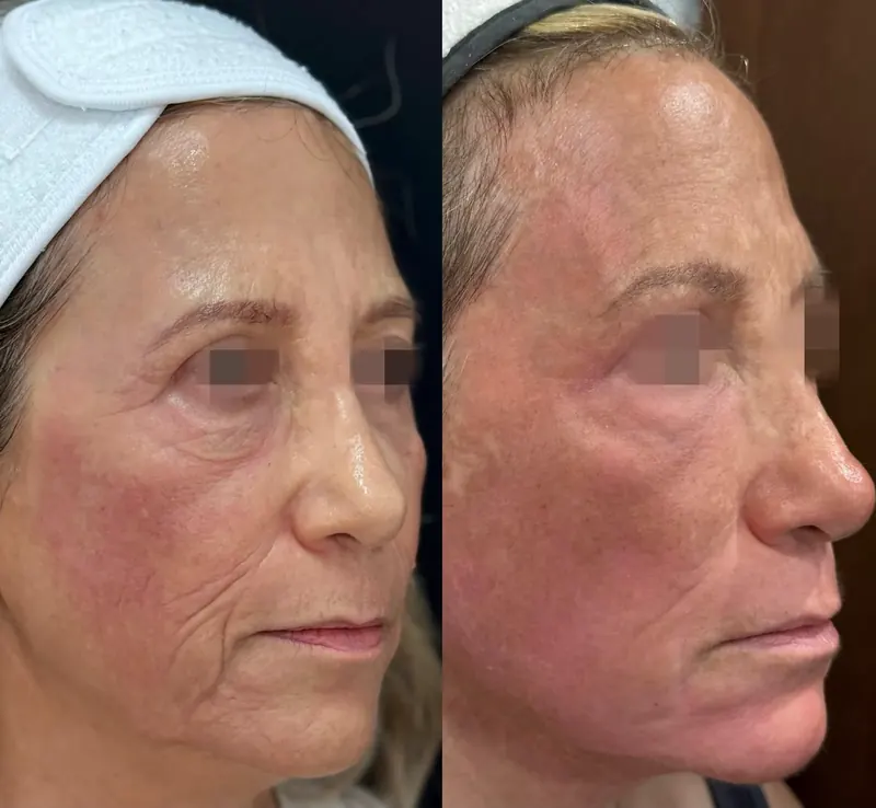 Antes y después: rejuvenecimiento facial con láser co2. Paciente real