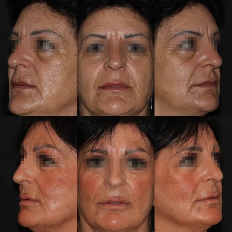 Antes y después: rejuvenecimiento facial con láser co2 · 6 meses. Paciente real