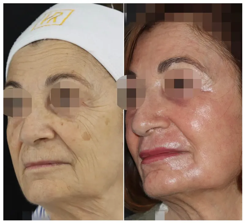 Antes y después: rejuvenecimiento facial con láser co2. Paciente real