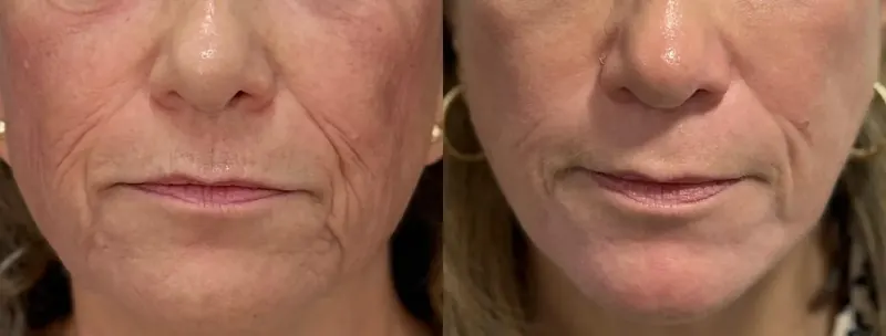 Antes y después: arrugas peribucales con láser co2. Paciente real