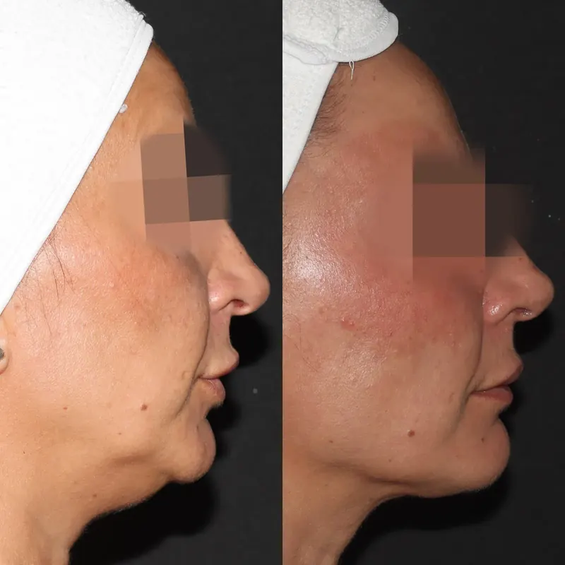 Antes y después: papada y óvalo facial. Paciente real