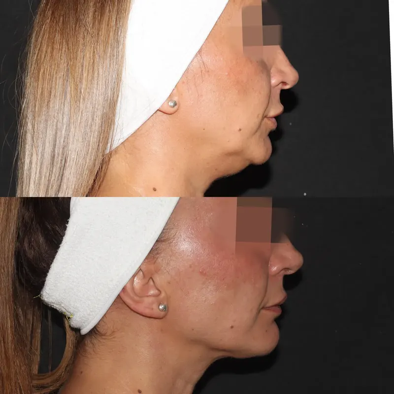 Antes y después: papada y óvalo facial. Paciente real