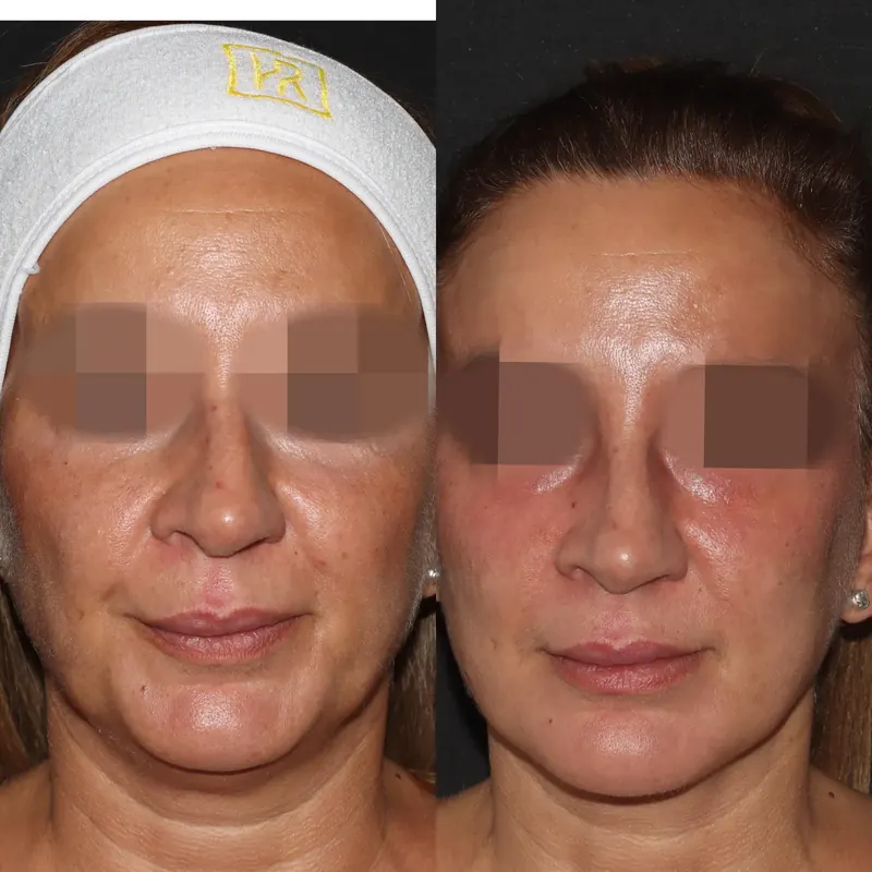 Antes y después: papada y óvalo facial. Paciente real